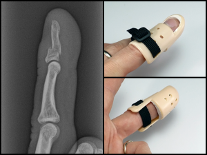 Broken Finger